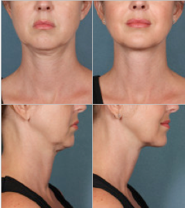 Kybella